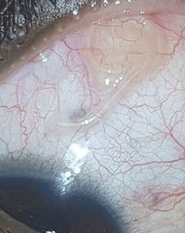 NEOflorax helps get rid of eye worms