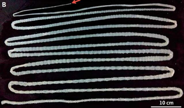 Tapeworm from human body