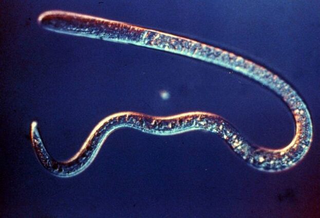 Trichinella spiralis from humans