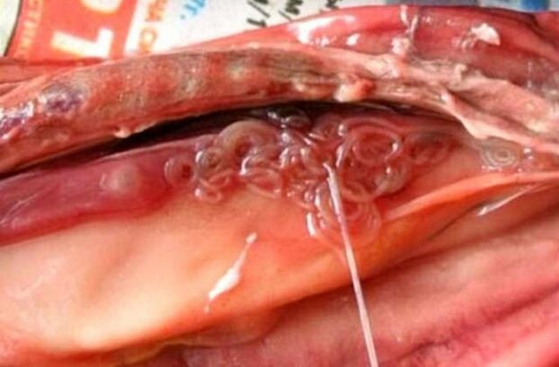 fluke in gallbladder