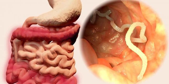 Worms are parasites of the human body